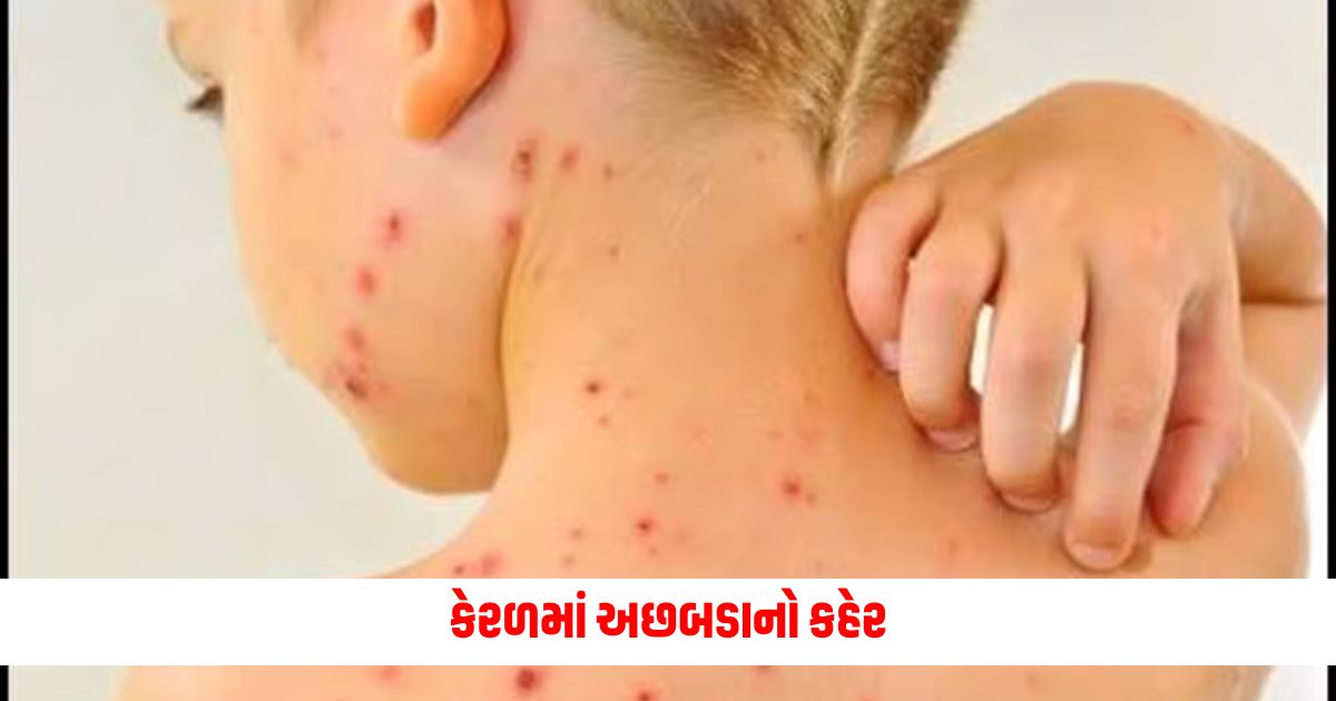 Chicken pox outbreak in Kerala know the symptoms and remedies for the disease 1