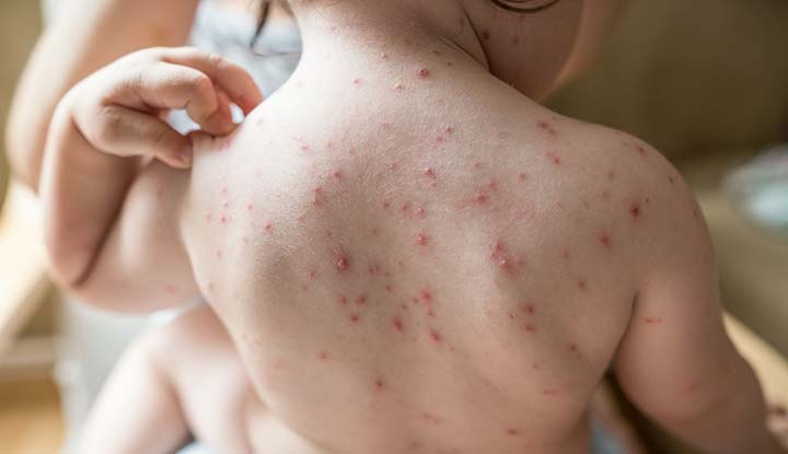 Chicken pox outbreak in Kerala know the symptoms and remedies for the disease