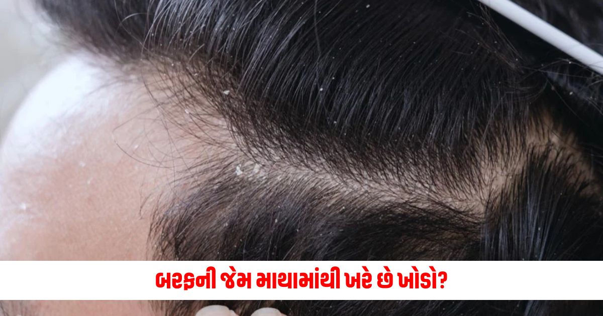 So get rid of dandruff forever with these 4 ways 1