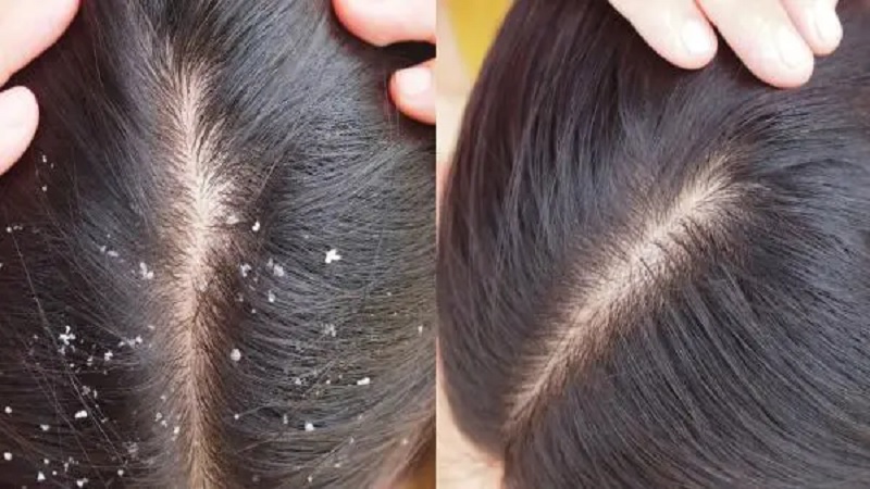 So get rid of dandruff forever with these 4 ways