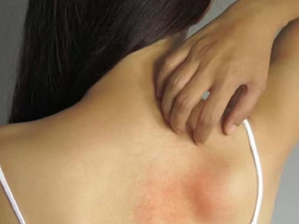 If you are suffering from sweating and itching in summer then follow this home remedy 1