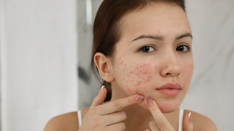 Why do acne appear on the body back and hands Try to reduce it with these tips 1