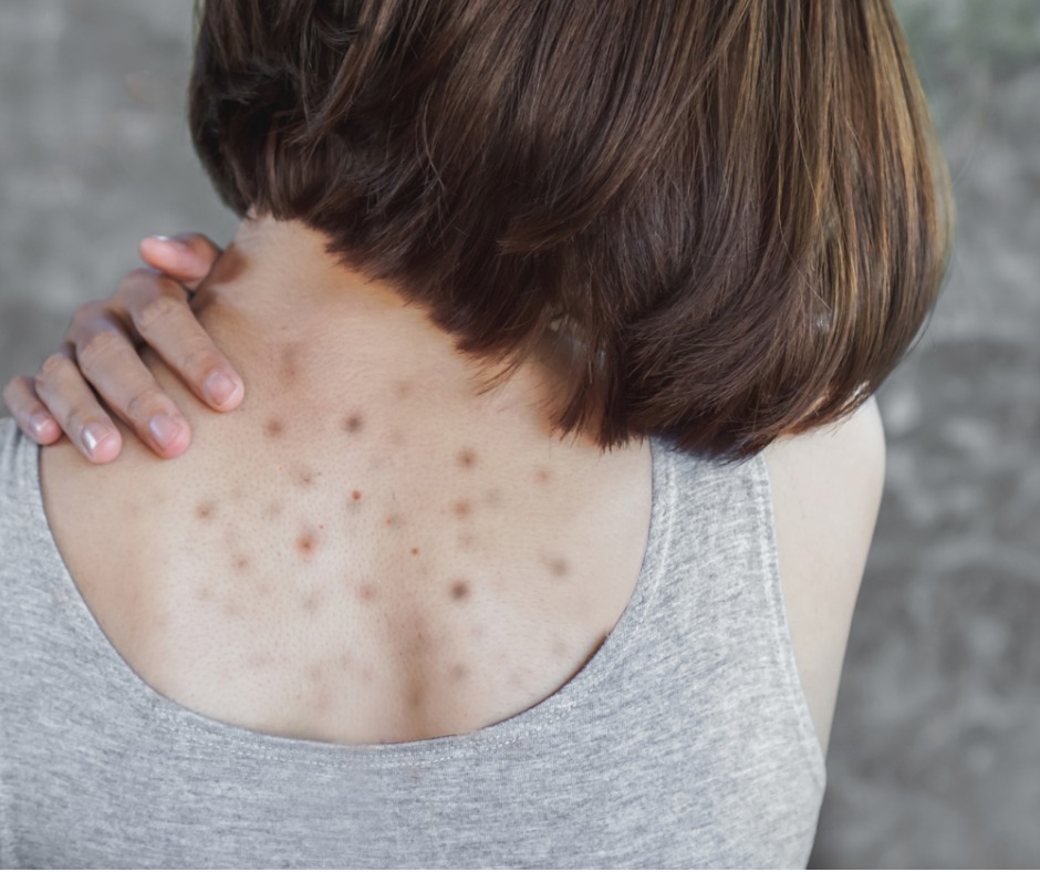 Why do acne appear on the body back and hands Try to reduce it with these tips 2