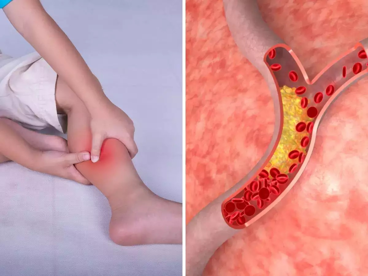 how to get high cholesterol symptoms from your feet leg pain skin colour cold toe1