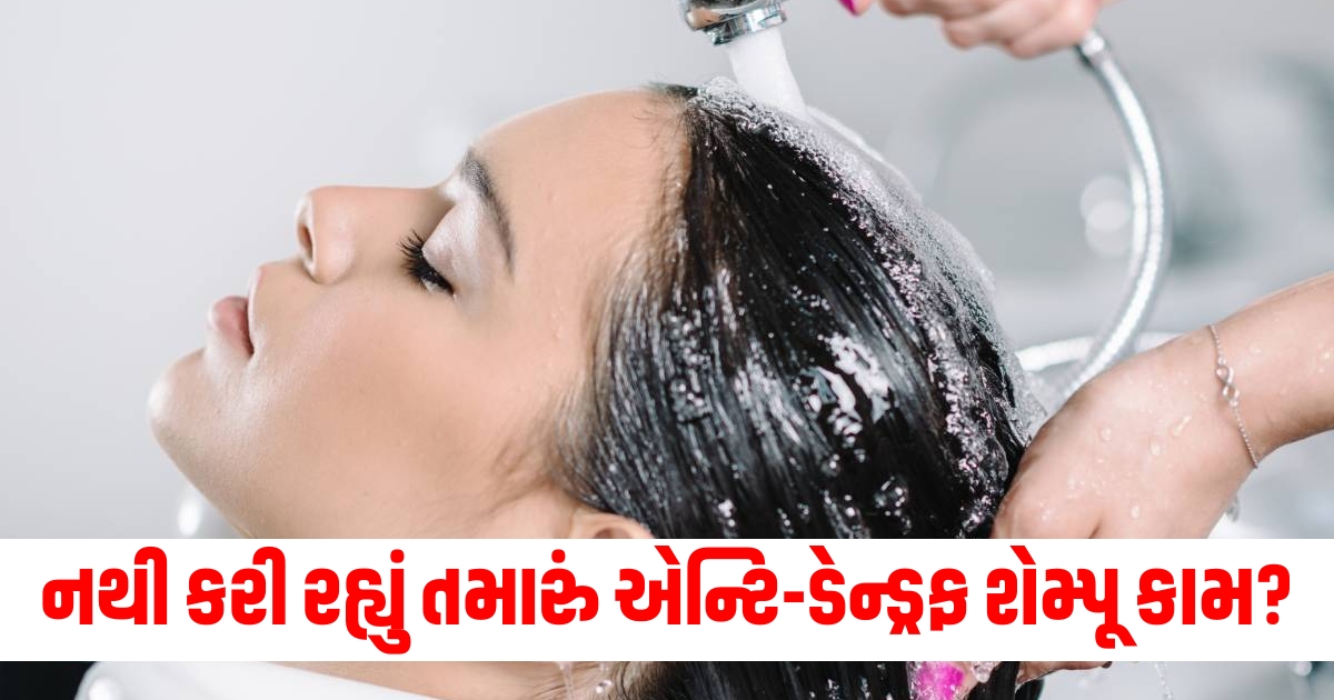 if anti dandruff shampoo is not working then use this one thing to get rid of stubborn dandruff f