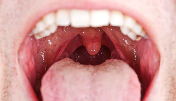 mouth cancer causes symptoms prevention and care tips 1