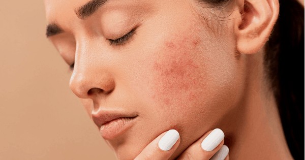 unhealthy habits that are ruining your skin health 2