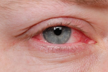 home remedies to prevent conjunctivitis or to get relief from pink eye 1