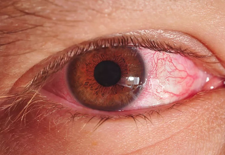 home remedies to prevent conjunctivitis or to get relief from pink eye 2