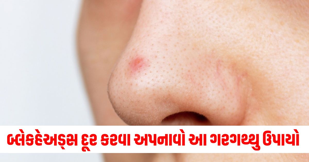 how to remove dark spots on nose home remedies for blackheads naak par jama kale daag kaise hataye