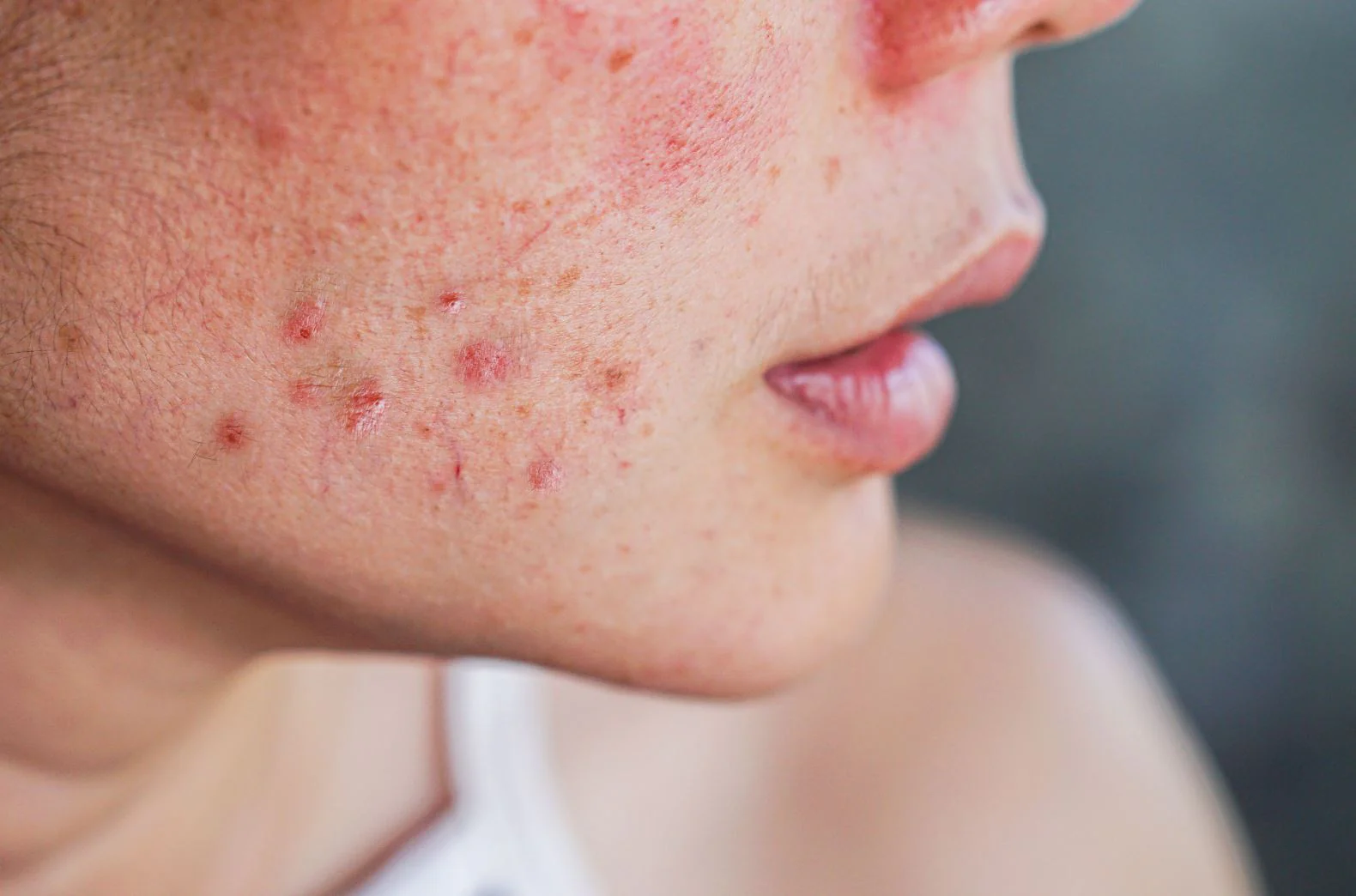 skin care tips why you should not popping your pimples know the risks here sad