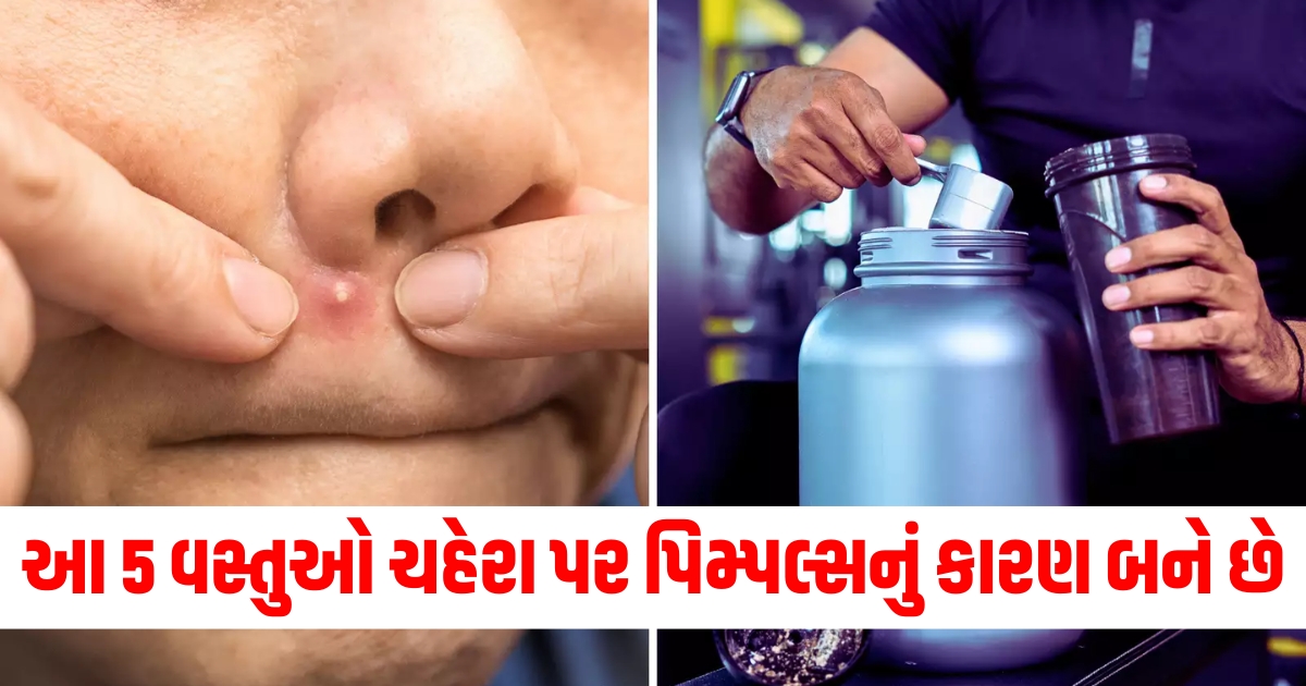 આ 5 વસ્તુઓ ચહેરા પર પિમ્પલ્સનું કારણ બને છે