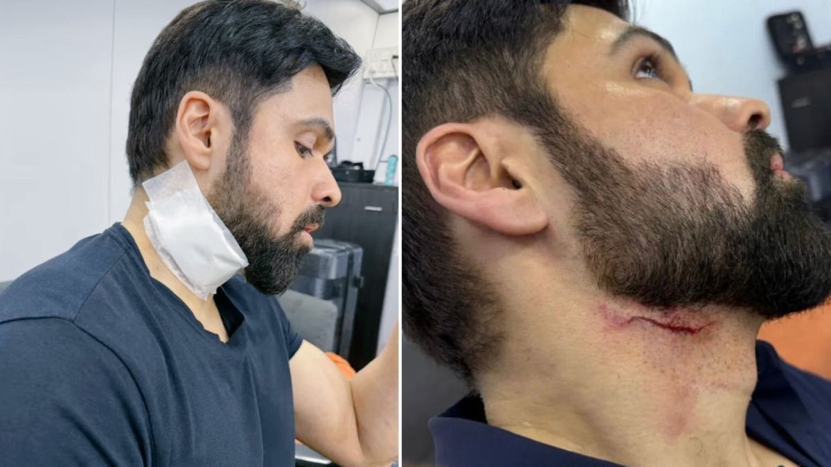 emraan hashmi gets injured while shooting of adivi sesh goodachari 2 in hyderabad