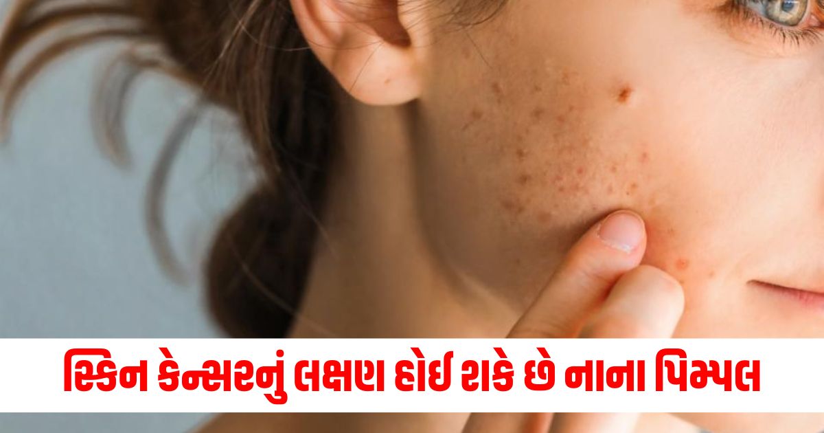 womans pimple on forehead turns out to be skin cancer know the can pimple be a sign of skin cancer