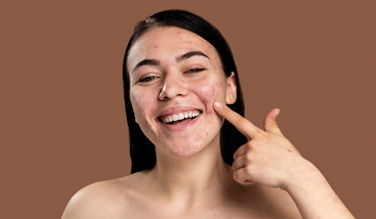 beauty you should not burst pimples as soon as you see them know the myths and facts