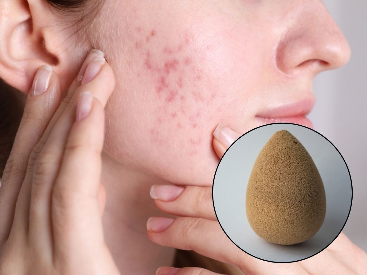 can beauty blender cause acne know how to avoid this problem1