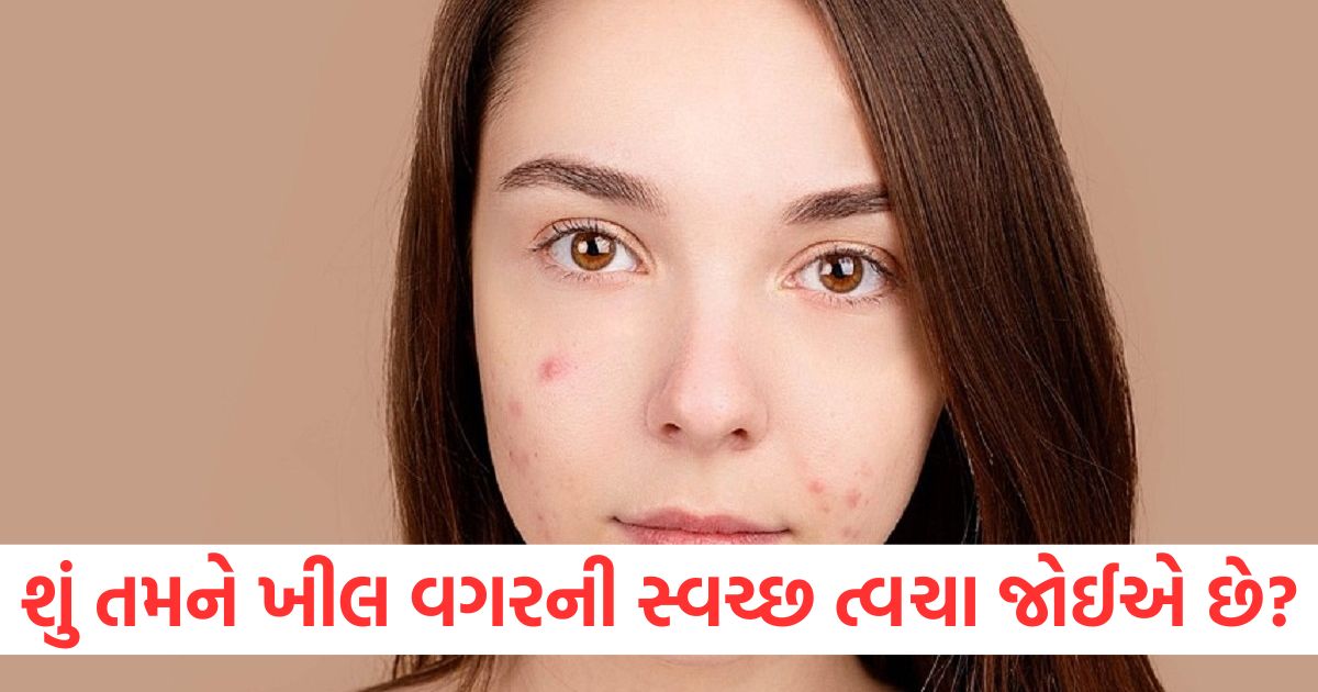 home remedies to get rid of pimples before valentines day