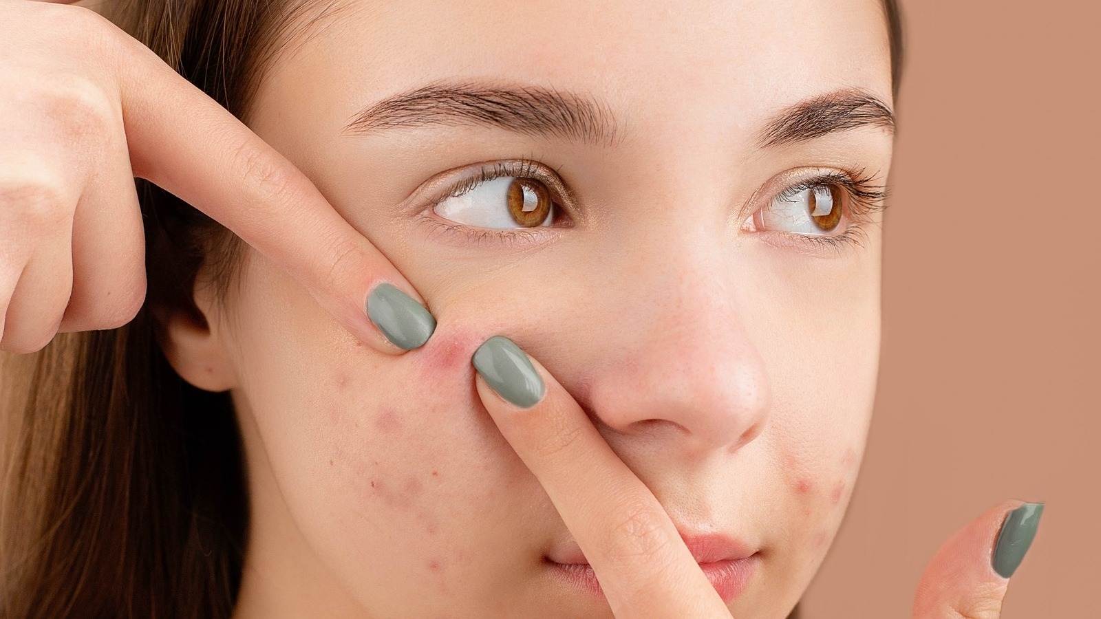 home remedies to get rid of pimples before valentines day1