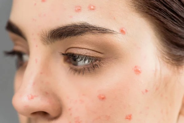 home remedies to get rid of pimples before valentines day2