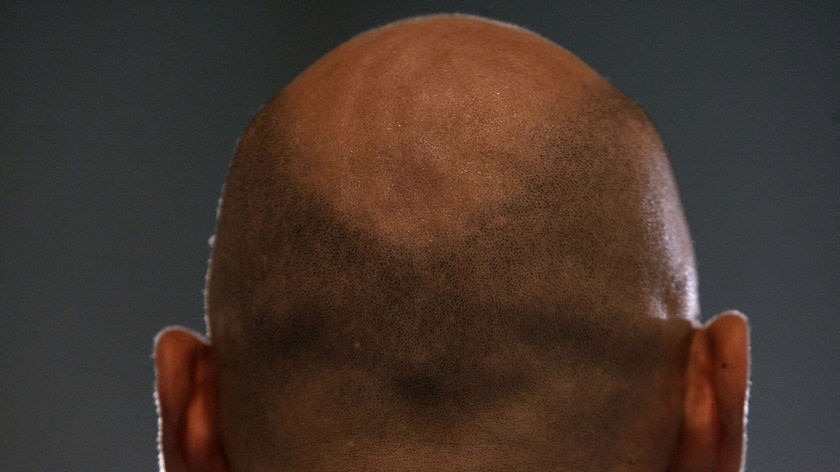 to avoid baldness use this remedy twice week effect visible in few months2