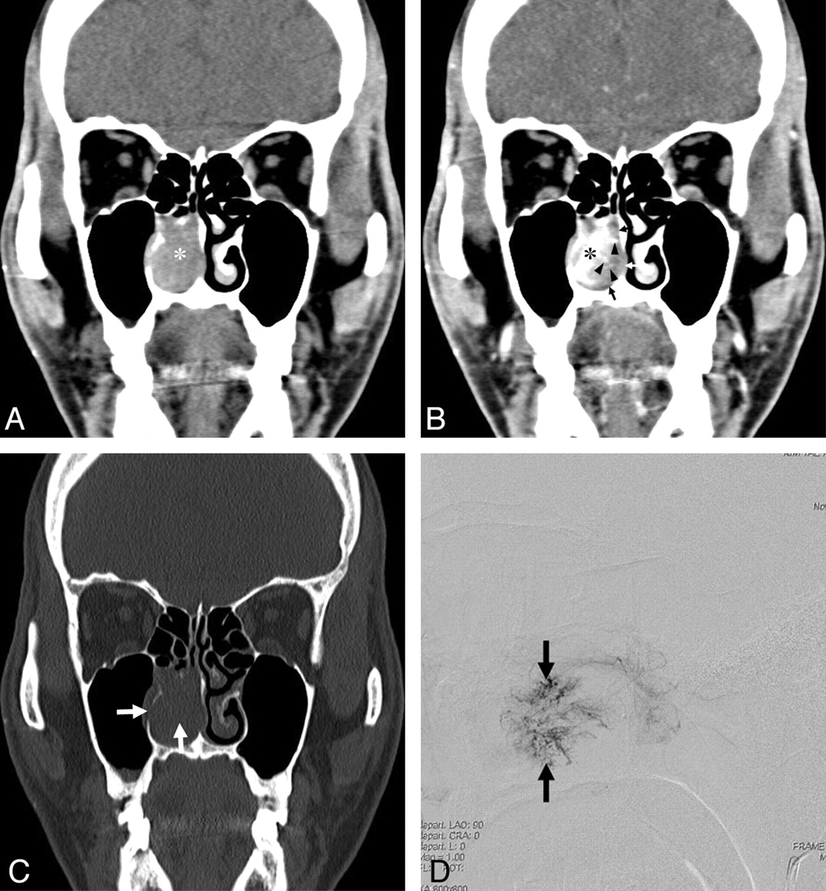 Worlds second and Indias first rare Anastomosing Hemangioma case in nasal septum in Rajkot